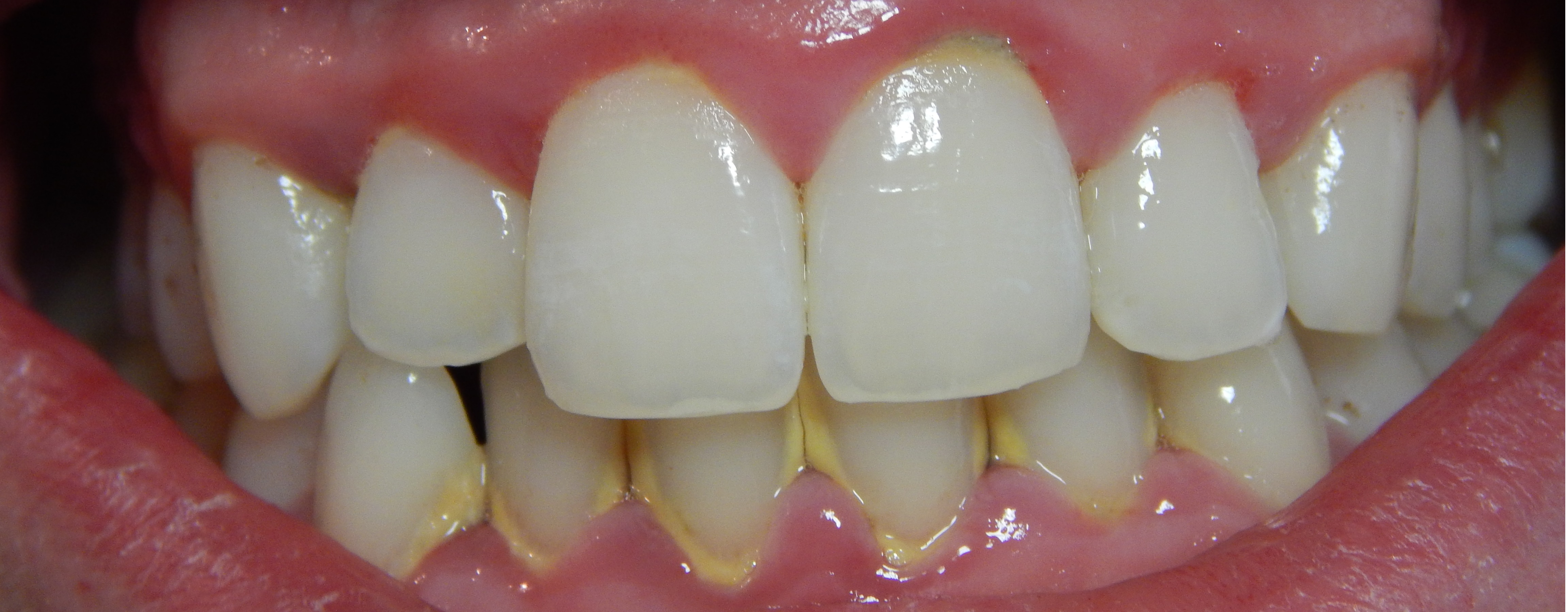 牙龈出血怎样治疗比较好-成都极光口腔医院