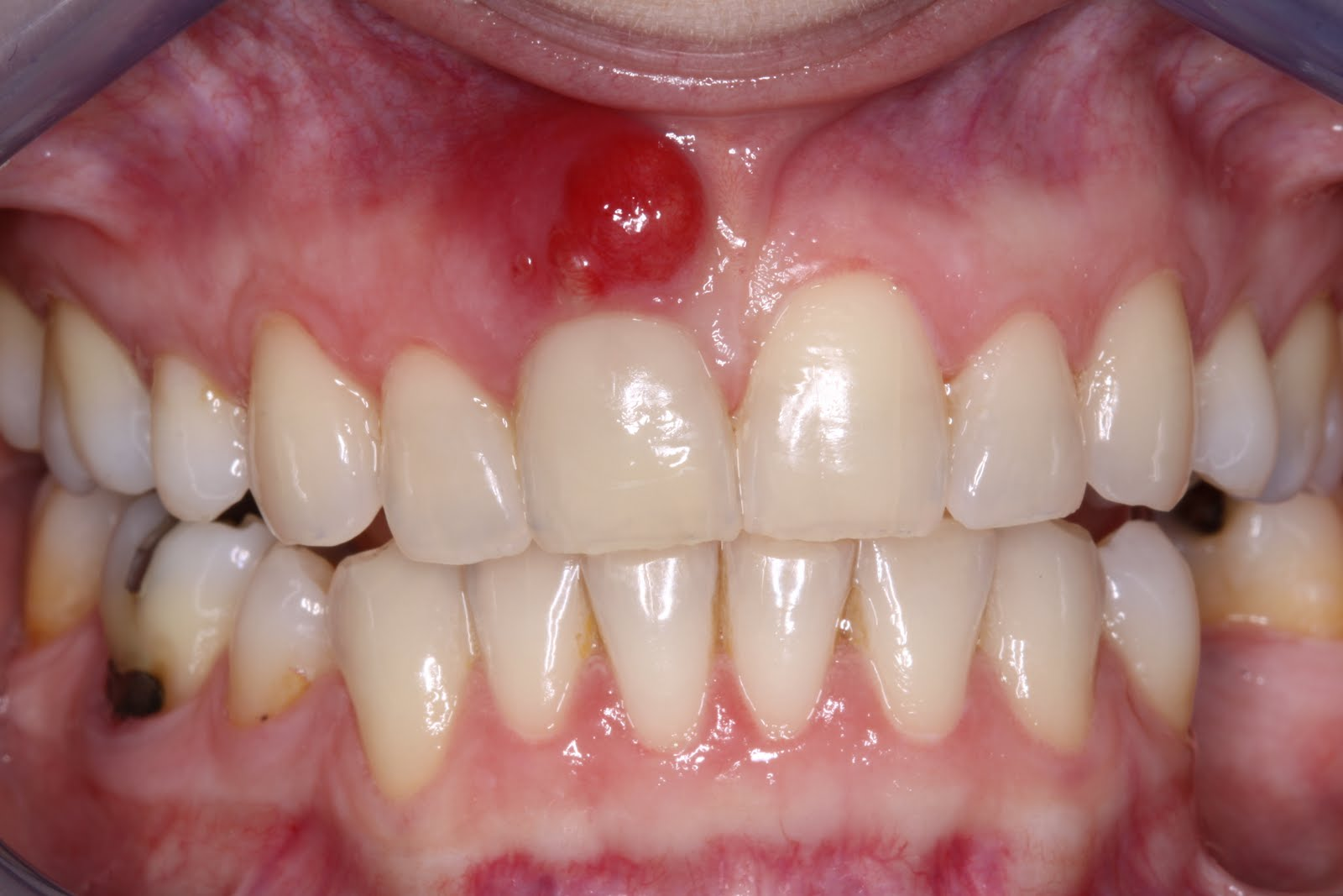 Abscesso Dent rio Causas Tratamento Preven o abscesso dent rio causas tratamento preven o